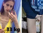 Mladá žena z Ruska trpela anorexiou, dnes je pre ženy s podobnými problémami veľkou inšpiráciou.