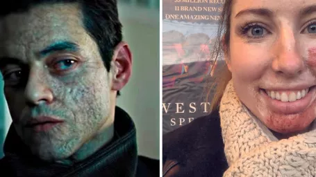 Rami Malek v najnovšom filme o Jamesovi Bondovi. / Catrin Pughová, ktorá žije s rozsiahlymi popáleninami.