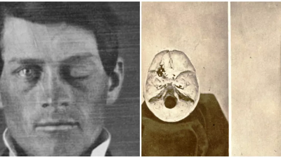 Američan Phineas Gage prežil prebodnutie mozgu šesťkilovou tyčou a po nehode žil ešte 12 rokov.